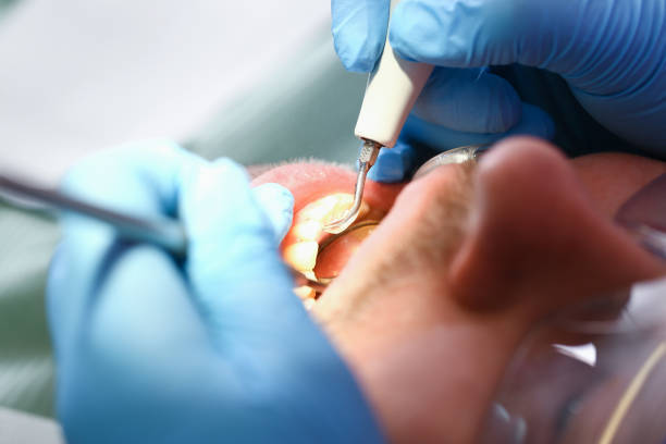 Best Knocked-Out Tooth (Avulsed Tooth) Treatment in Mount Sterling, IL